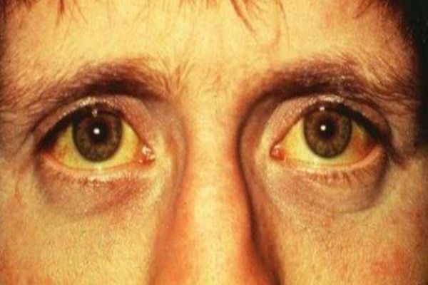 اصفرار الوجه المفاجئ اصفرار الوجه المفاجئ