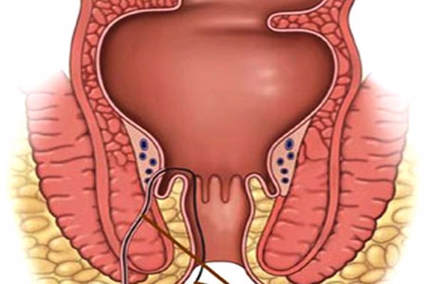 علامات شفاء الناسور