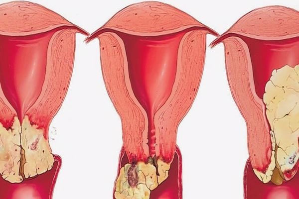 أعراض التهاب المهبل الفطري