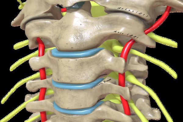 علاج ضغط فقرات الرقبة على الأعصاب