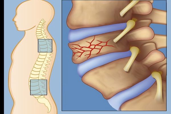 أعراض ضغط الفقرات الرابعة والخامسة