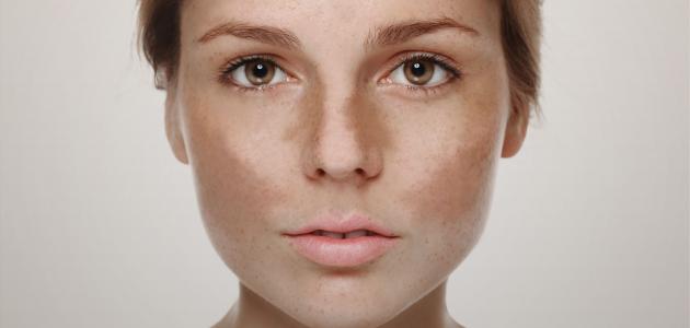 ما هي أعراض الكلف ما هي أعراض الكلف