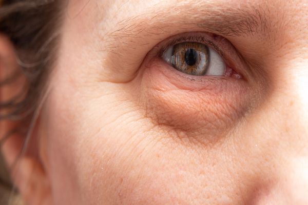 هل القولون يسبب انتفاخ تحت العين