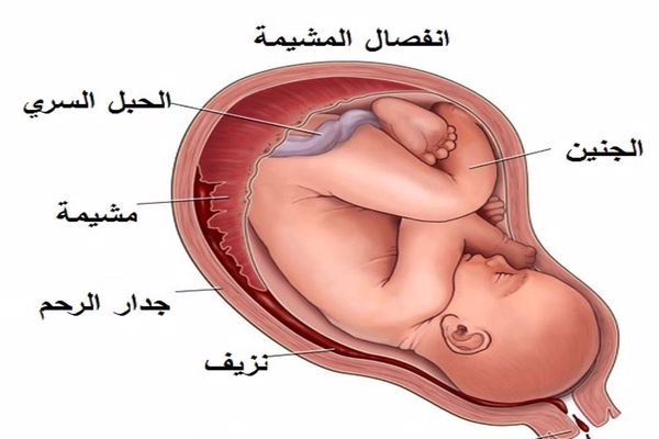 أسباب انفصال المشيمة