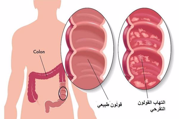 أعراض القولون التقرحي