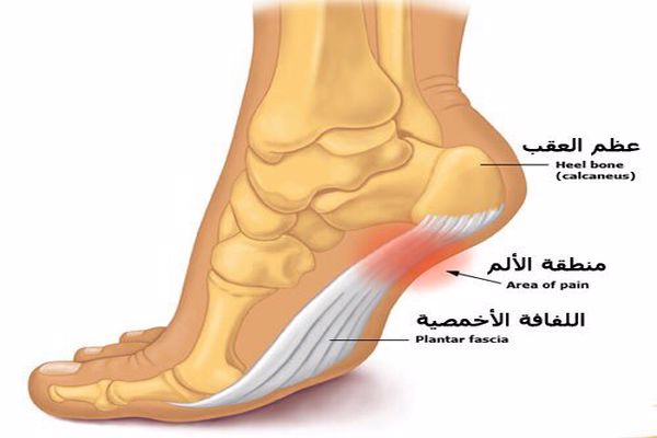 ما هي اعراض التهاب اللفافة الأخمصية