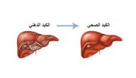 ما علاج الدهون على الكبد