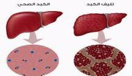 أعراض التهاب الكبد C