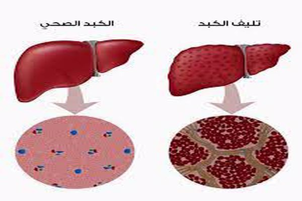 أعراض التهاب الكبد C