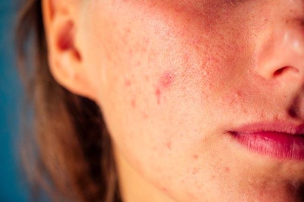 ما سبب ظهور بقع حمراء في الوجه فجأة