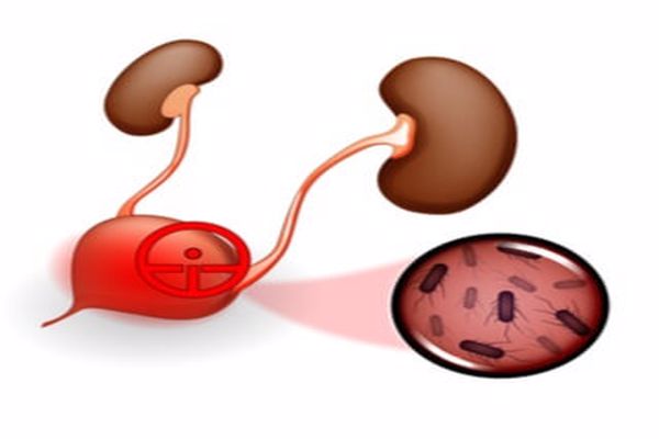 مضاد حيوي لعلاج التهاب المثانة