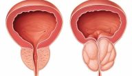هل التهاب البروستاتا يزول بدون علاج