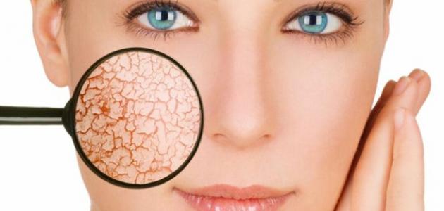 العلاجات الطبيعية لجفاف البشرة