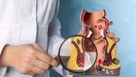 علاج البواسير الخارجية المنتفخة