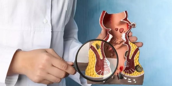 علاج البواسير الخارجية المنتفخة