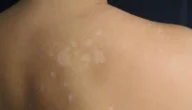 علاج التنيا البيضاء