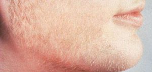 علامات ارتفاع هرمون الذكورة عند النساء