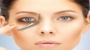 ما هي الخلطات الطبيعية للهالات السوداء حول العين؟