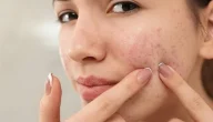 تجارب علاج حب الشباب بدون أدوية