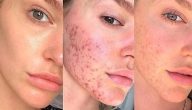 وصفات طبيعية لتقليل حب الشباب بسرعة
