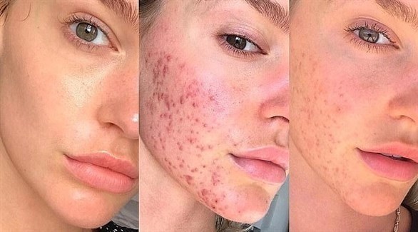 وصفات طبيعية لتقليل حب الشباب بسرعة