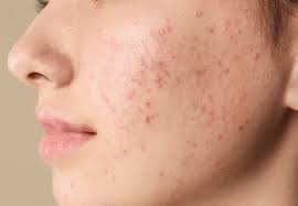 كيف أجعل وجهي صافي من الحبوب طبيعياً؟