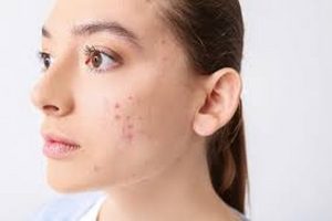 اسرار الاطباء لعلاج الحبوب نهائيًا في المنزل