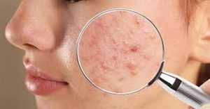 أفضل علاج لحب الشباب من الصيدلية