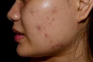 اسرع خلطة لازالة الحبوب من الوجه؟