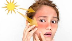 ماسك لعلاج حروق الشمس وتبيض الوجه مجربة