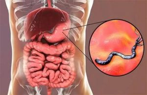 علاج جرثومة المعدة في المنزل